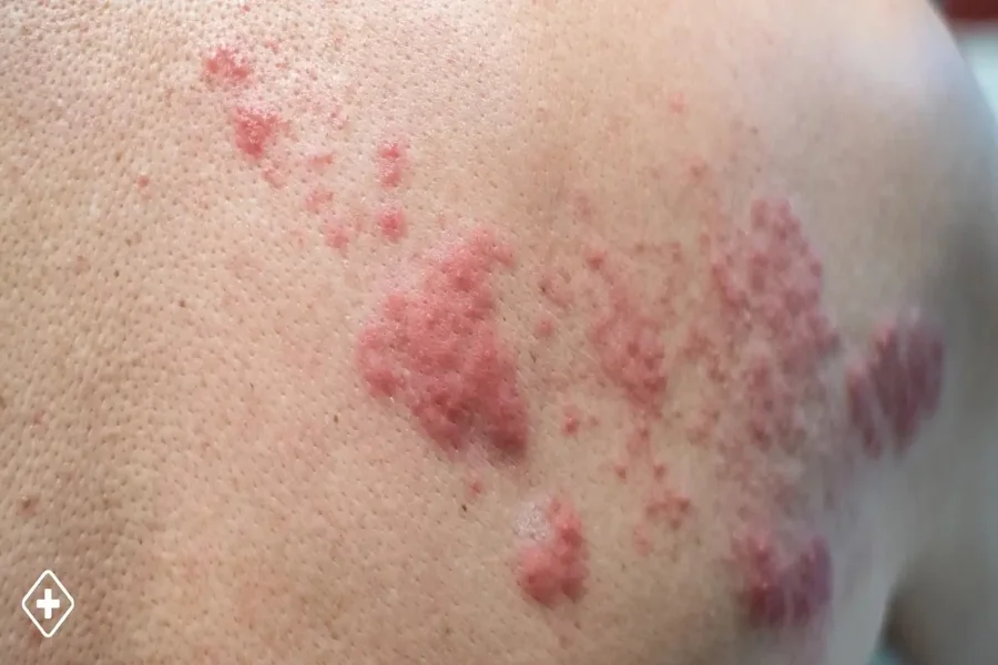 Shingles Rash in Spanish