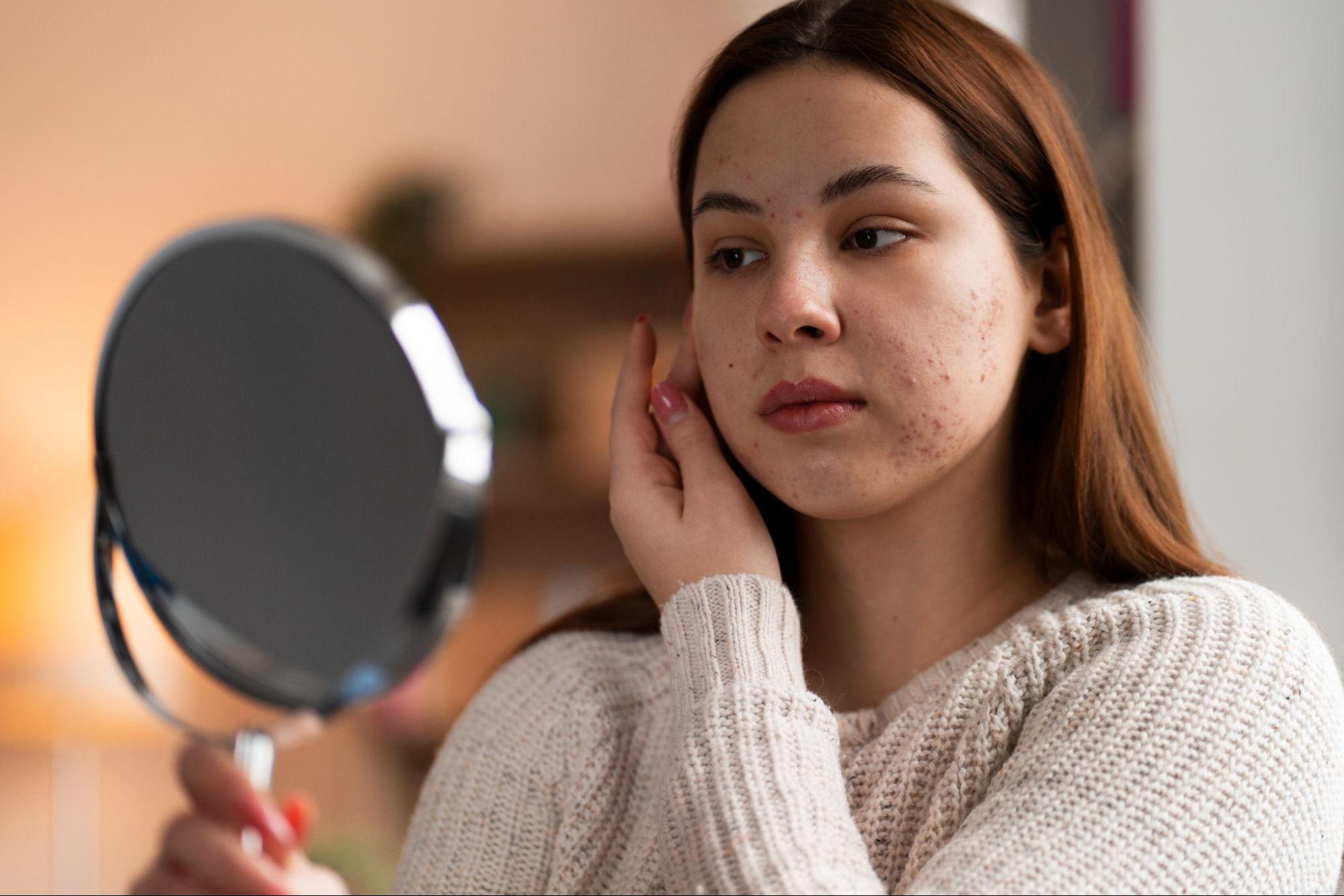 Understanding and Managing Body Acne: Causes, Types & Treatment