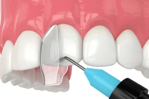 Top 10 London Cosmetic Dental Clinics for Chipped Tooth Repair